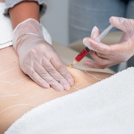 Lipo Enzimática – Clínica de Estética BH