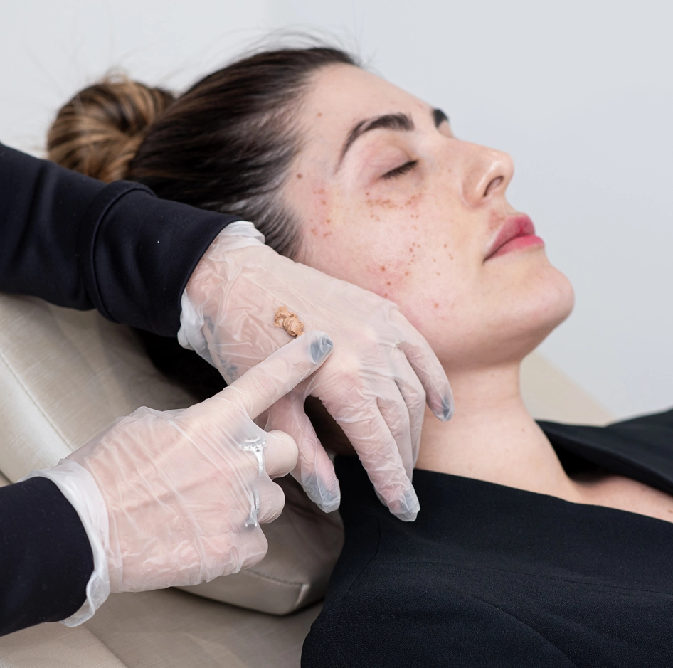 Peeling Químico Clínica de Estética BH