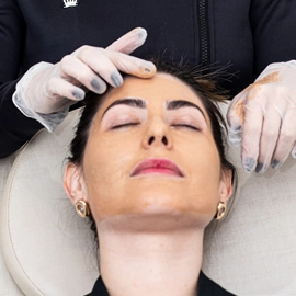 Peeling Químico – Clínica de Estética BH
